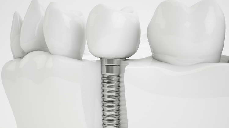 dental implant in graphic
