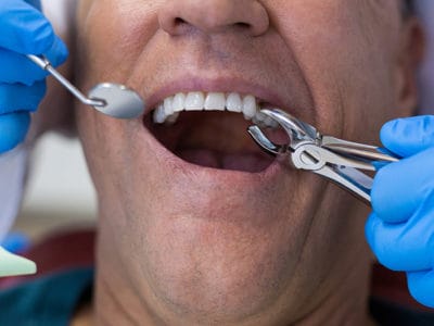 Tooth Extractions