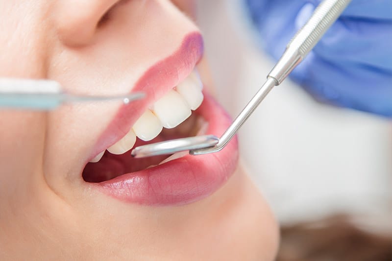 Seamless Dental Bonding: Enhance Your Smile with Confidence!