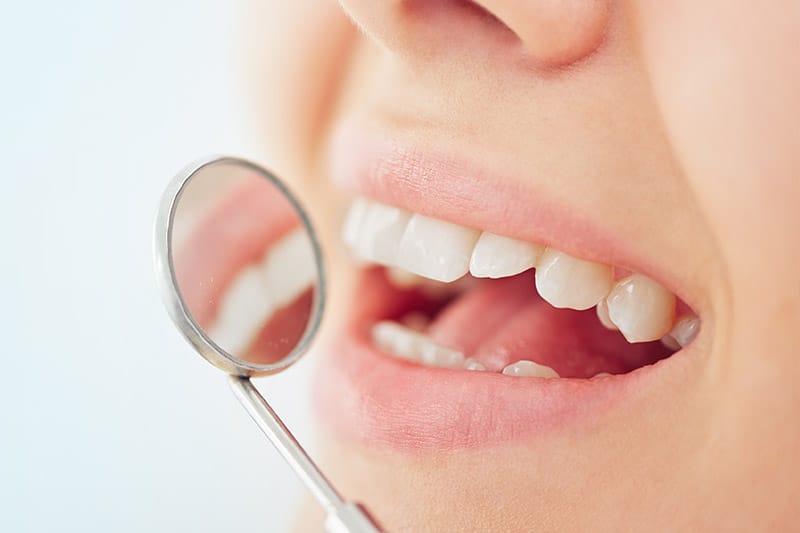 Teeth Whitening in Cincinnati, Ohio Bright Smiles