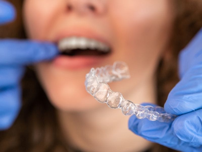 Invisible Teeth Alignment: Transform Your Smile with Invisalign!