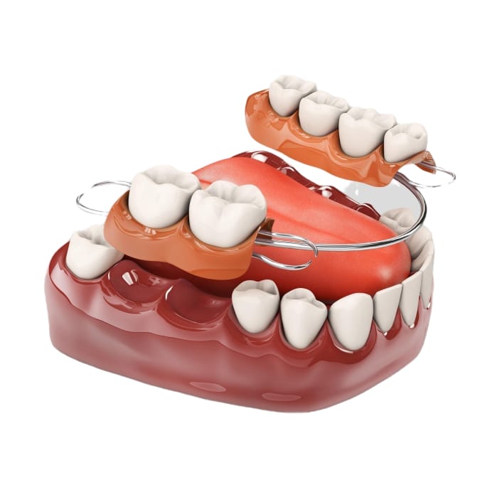 3D image of partial denture